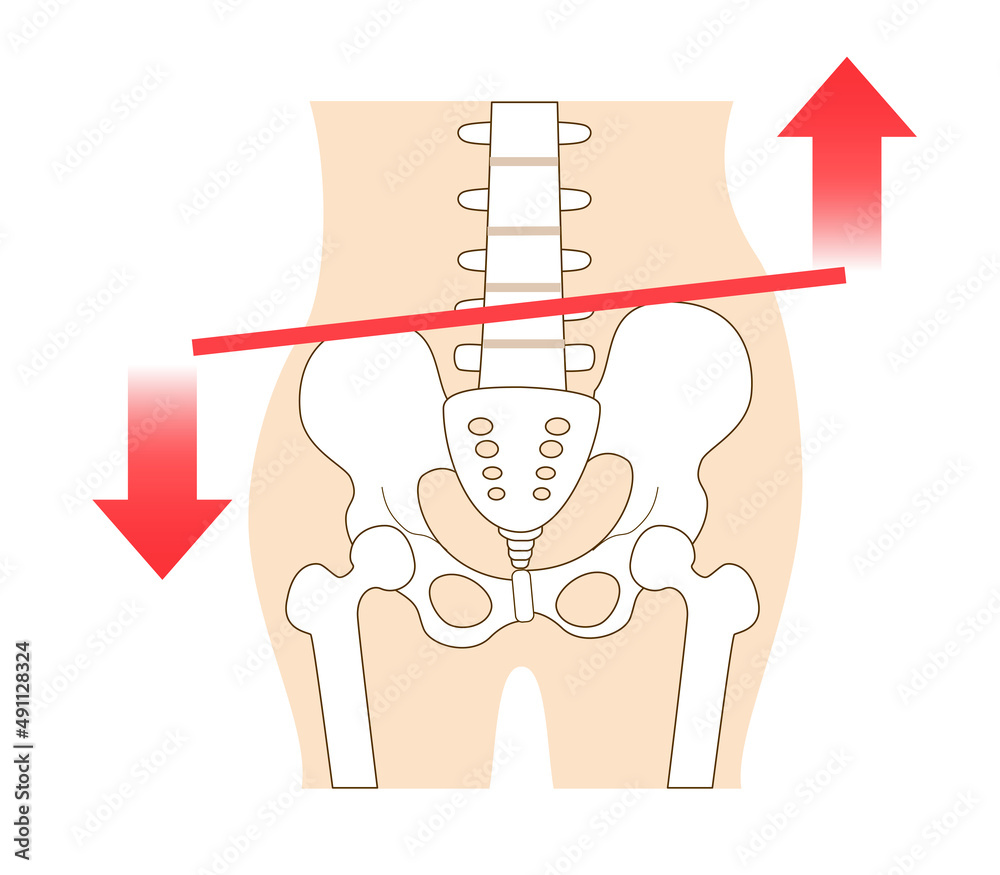 Left Tilted Left-right tilted pelvis and posture. Stock Vector | Adobe Stock