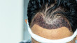Man head with hair transplant surgery with receding hair line, FUE, Follicular unit extraction, Types of hair transplant procedures and their stages. Male alopecia treatment.