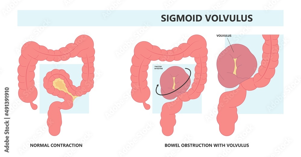 Colon Defect ileus bowel toxic small midgut cecal colon tract Hirschsprung's gastric ...