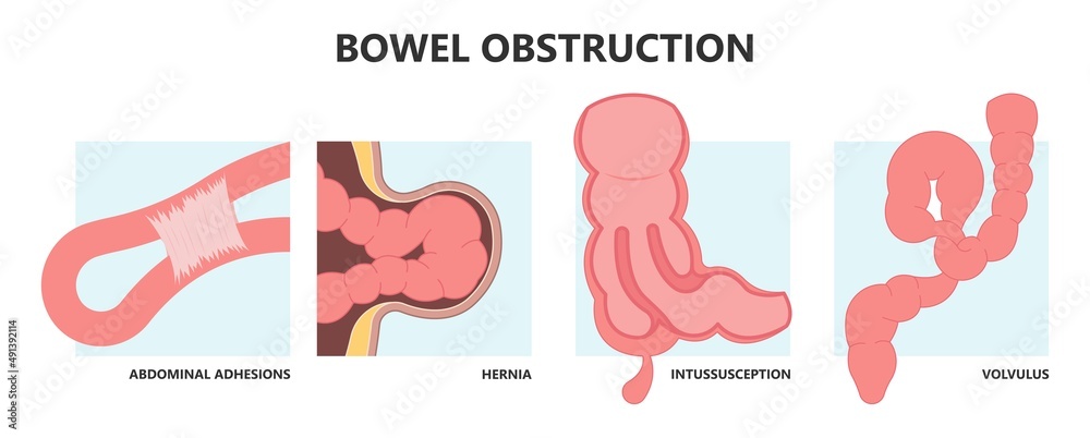 Colon Defect ileus bowel toxic small midgut cecal colon tract Hirschsprung's gastric ...
