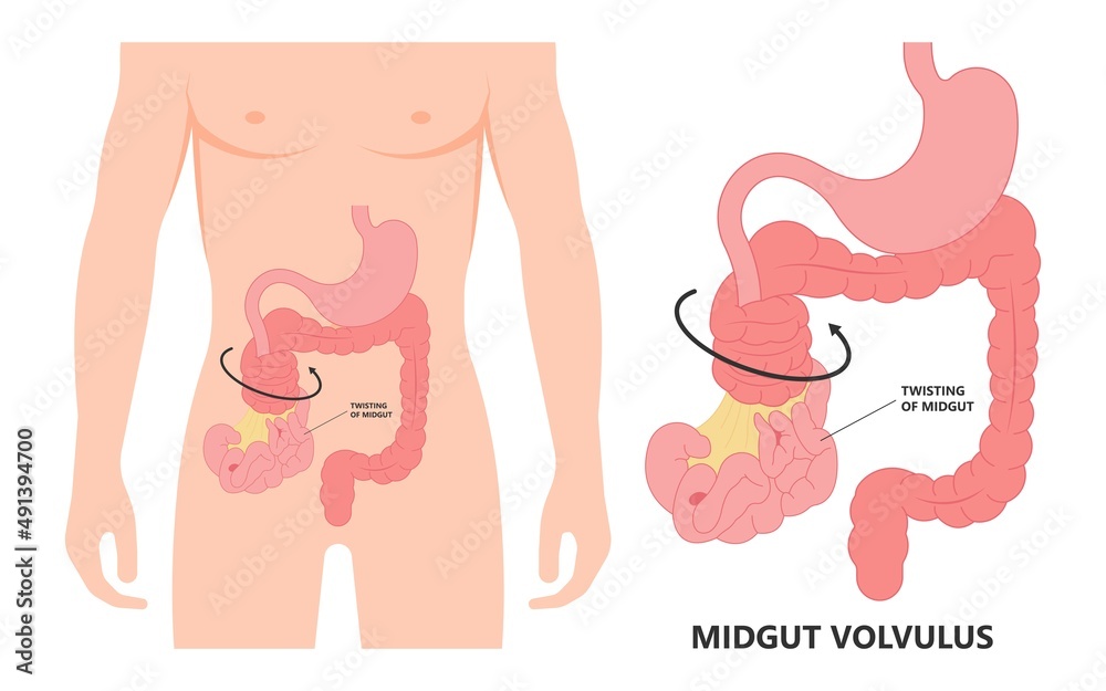 Colon Defect ileus bowel toxic small midgut cecal colon tract Hirschsprung's gastric ...