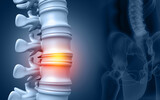 Fototapeta  - Lumbar intervertebral spine hernia. 3d illustration