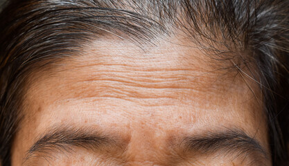 Skin creases or wrinkles at oily forehead of Southeast Asian, Myanmar or Burmese elder woman. Symptom of aging.