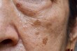 Small brown patches called age spots on face of Asian elder woman. They are also called liver spots, senile lentigo, or sun spots.