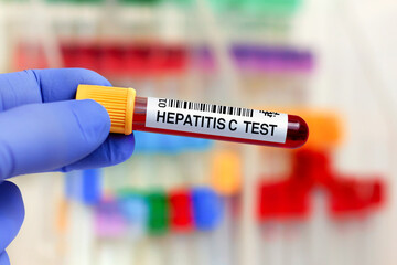 Wall Mural - Blood sample for study of Hepatitis C Virus HCV in the lab. doctor holding Blood tube for HCV Hepatitis C Virus analysis and identification