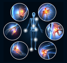 Painful Joints, Rheumatoid Arthritis, Osteoarthritis, 3D Illustration
