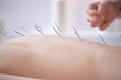 © alfa27 - hand of professional doctor performing acupuncture therapy for female client. woman undergoing acupuncture treatment with a line of fine needles inserted into the her body skin in clinic hospital