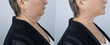 Photos before and after plastic surgery to remove Venus rings. Contour plastics of the neck, mesotherapy or botulinum therapy. Wrinkles and creases in the neck