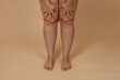 © Юля Бурмистрова - Cropped photo of woman bare naked legs, pinching fat on knees. Clipping fat folds. Removal of fat knees, liposuction of edematous skin. Varicose vein, dehydrated thick skin. Body care. Fat loss