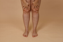 Cropped Photo Of Woman Bare Naked Legs, Pinching Fat On Knees. Clipping Fat Folds. Removal Of Fat Knees, Liposuction Of Edematous Skin. Varicose Vein, Dehydrated Thick Skin. Body Care. Fat Loss