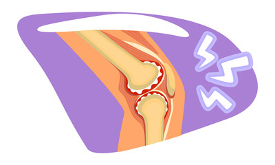 Poster - knee pain 2d vector isolated illustration. ruptured ligament risk flat sticker on cartoon background