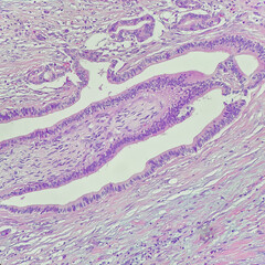 Wall Mural - Camera photo of cholangiocarcinoma with perineural invasion, magnification 200x, photograph through a microscope