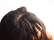 Closeup Woman with dandruff in her hair. Problem health care concept.