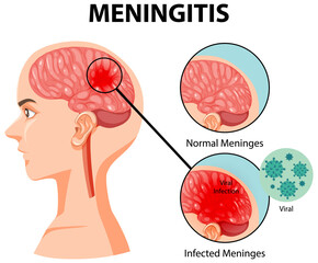 Canvas Print - Diagram showing meningitis in human brain
