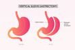 Vertical sleeve gastrectomy surgery  medical illustration.