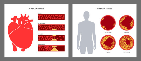 Canvas Print - Cholesterol heart disease