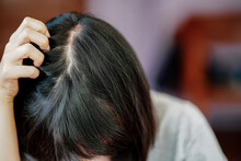 A Woman Has Hair Loss And Is So Thin That She Can See Her Scalp.