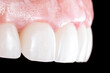 © Garo - crowns and venners b1 color