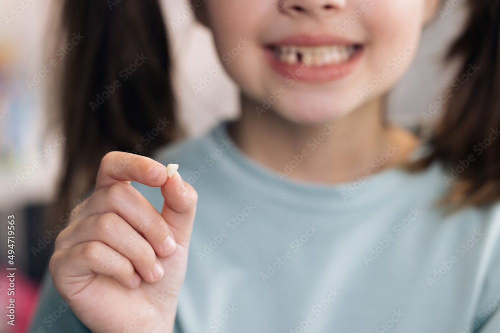 Little Girl Loosing her baby teeth. Little girl with milk temporary tooth. Happy child holding her fallen tooth in hand. Dental medicine or temporary teeth health care concept.