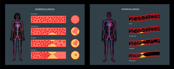 Poster - Cholesterol and atherosclerosis