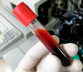 Poster - Hemolyzed blood sample in the hand of scientist. Hemolysis sample can cause false laboratory result.