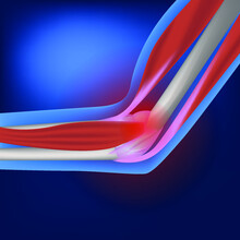 Epicondylitis Of The Elbow Joint. Inflammatory And Degenerative Lesion Of Soft Tissues. Orthopedic Pathology. Vector Illustration