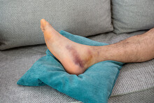 Ankle Injury With Dislocation And Sprains. Fracture Or Leg Sprain Injury Of Young Sports Man. 