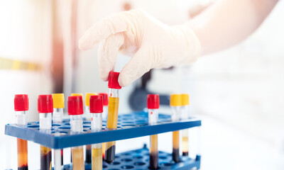 Wall Mural - lab worker preparing test blood for detection of antibodies and infections corona virus, sun light