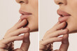 © Igor - Woman's face side view close-up before and after Botox lip filler injections. Lip augmentation. Thin ugly lips before the Botox procedure and beautiful perfect lips after the augmentation procedure.