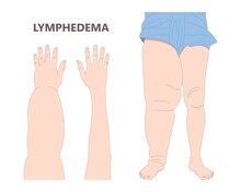 Leg Edema Venous Syndrome Milroy Deep Vein Cancer Swelling Upper Limb Wrap Calf Ulcer Meige Lymph Node Arms Hand Pain Cloth Blood Feet Ankle Liver Kidney Heart Lung Non Nonpitting Pedal