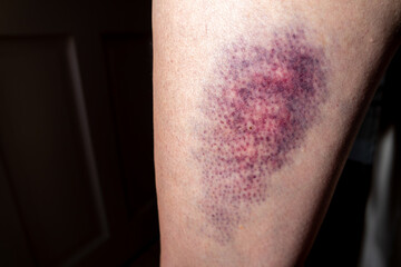 Terrible bruise on the upper leg of a woman