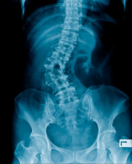Naklejka na meble X-ray image of abdomen show spine and pelvic bone, lumbar spondylosis and degenerative change and deformity in scoliosis shape