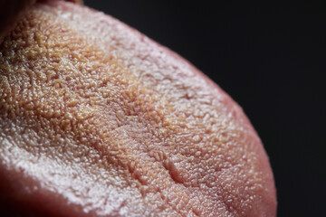 tongue with ulcers of adult man.Cracks in the tongue of a young man.man with halitosis for candida albicans on tongue.