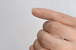 Close-up of broken nail, an injury to little finger of caucasian hand