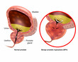 Medical vector illustration showing Benign prostatic hyperplasia BPH and Normal prostate. Prostate gland enlargement