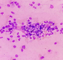 Wall Mural - Chronic myeloid leukemia(CML) is a type of blood cancer. show the increased and unregulated growth of myeloid cells, mononuclear cells in blood smear.