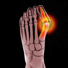 Poster - Toe deformation, also known as hallux valgus, or bunion