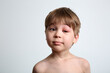 A boy with swollen eye from insect bite. Quincke edema. Portrait of Caucasian appearance child looking at the camera. Studio background. Isolated. Face of allergic person. Copy space. Studio. Allergy