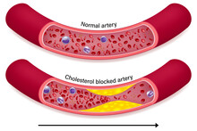 The difference of normal artery and cholesterol blocked artery. Clogged arteries caused by cholesterol.