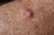 SCC or BCC skin cancer on senior males' leg waiting for surgery.