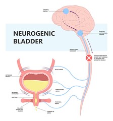 Cystitis urge pass urine of pelvic floor muscle frequently Bed wetting toilet urination older nerve brain spasm tract tumor cancer stroke stress atonic Benign Lower Often leak anuria Neural cord