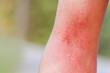 close up skin allergy itching on arm skin body allergic a caterpillar sting or insect bites dermatitis,Health care concept.
