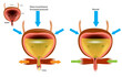 Overactive bladder OAB and Normal bladder.Illustration showing Detrusor muscle contracting when and before bladder is full.
