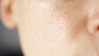 Leinwandbild Motiv Skin texture, unhealthy with with enlarged pores and rosacea, red rashes. Allergic and redness. Environmental impact on sensitive skin concept. 