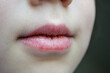 © Luci - Dry and damaged lips of a girl. Close-up. Lip fissure and bleeding. Sick cracked damaged tissue. Dry lips with cracks, dry mouth, Closeup face with brittle and dry lips, dehydration High quality photo