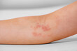 atopic dermatitis on the child's arm