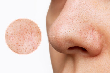 Wall Mural - Close up of female nose with blackheads or black dots and magnifying glass with an enlarged image of the pores on the face isolated on a white background. Acne problem, comedones. Cosmetology concept