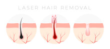 IPL Laser Hair Removal Verctor Illustration Concept