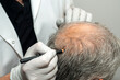 Marking hair line Point of receding hair line for hair transplant surgery.