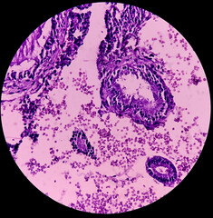 Poster - Endocervical tissue biopsy: Photomicrograph show part of ectocervix and few fragmented endocervical glands, Chronic endocervicitis.